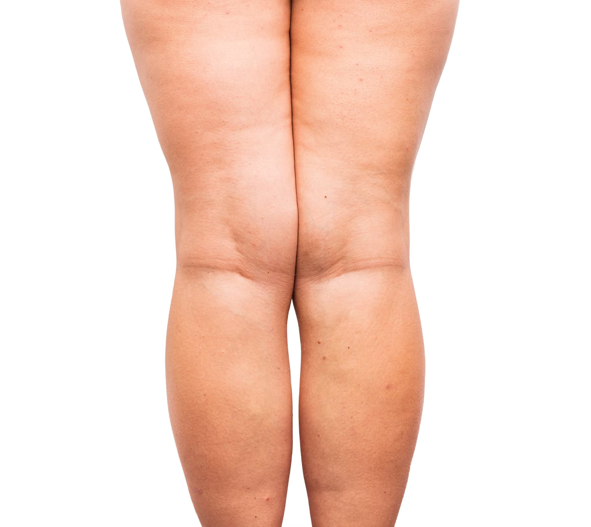Lipödem-Ernährungspläne: Die besten Lebensmittel für Ihre Gesundheit