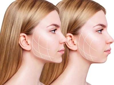 Kinn- und Kieferdefinition mit juvederm volux entdecken