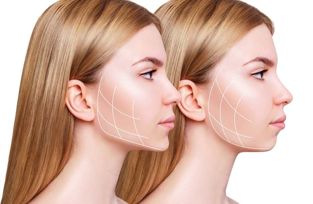 Kinn- und Kieferdefinition mit juvederm volux entdecken