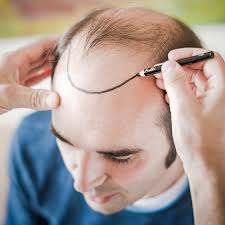 Haartransplantation Türkei Kosten: A Comprehensive Overview of Expenses